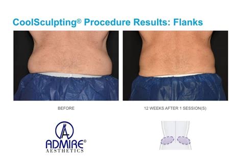 coolsculpting timeline|real coolsculpting results.